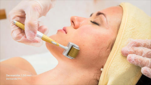 Vídeo demostrativo: uso del dermaroller en cuerpo para cicatrices finas y estrías moderadas (1,50 mm).
